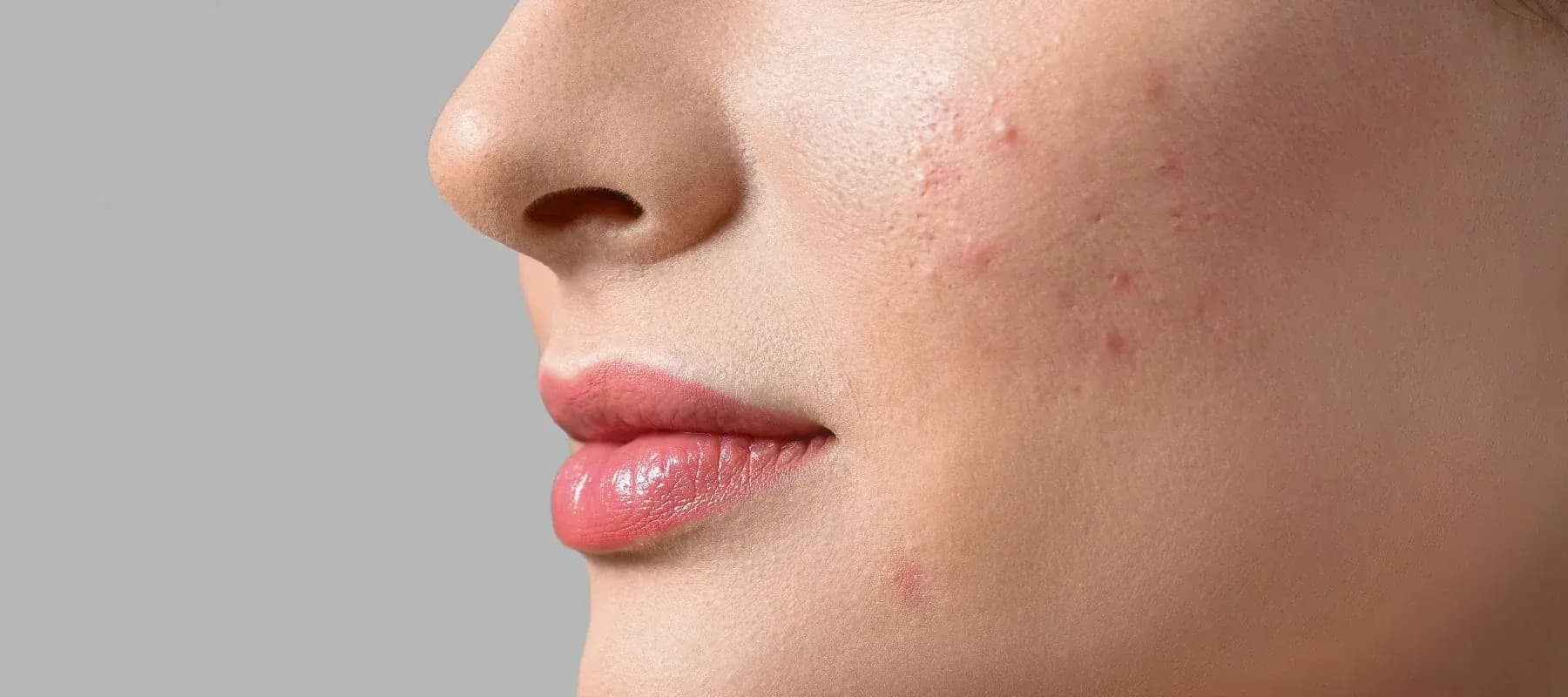 Acne & Breakouts product