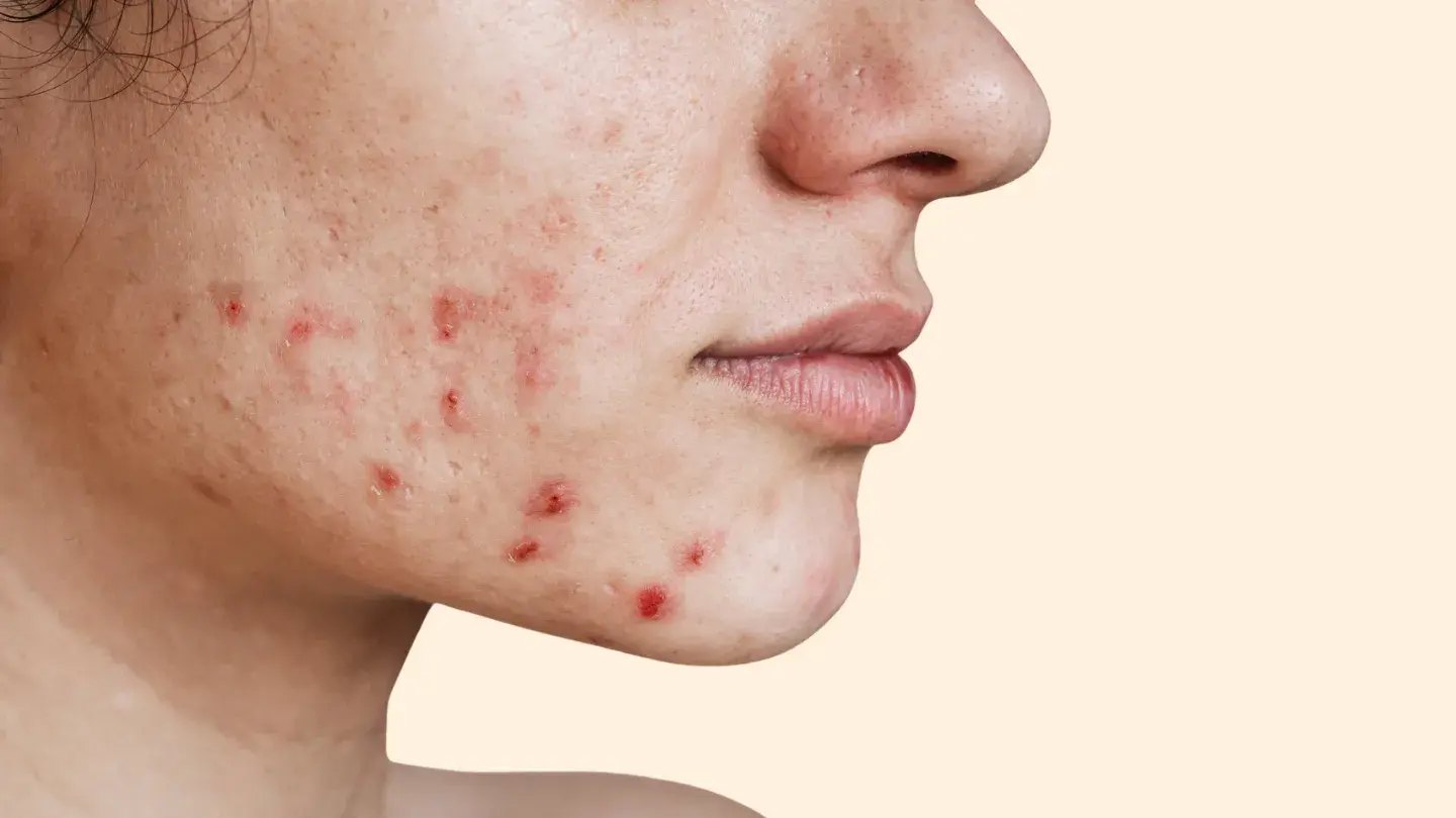 Acne & Breakouts secondary product