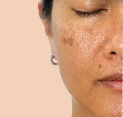 Pigmentation & Uneven Tone product