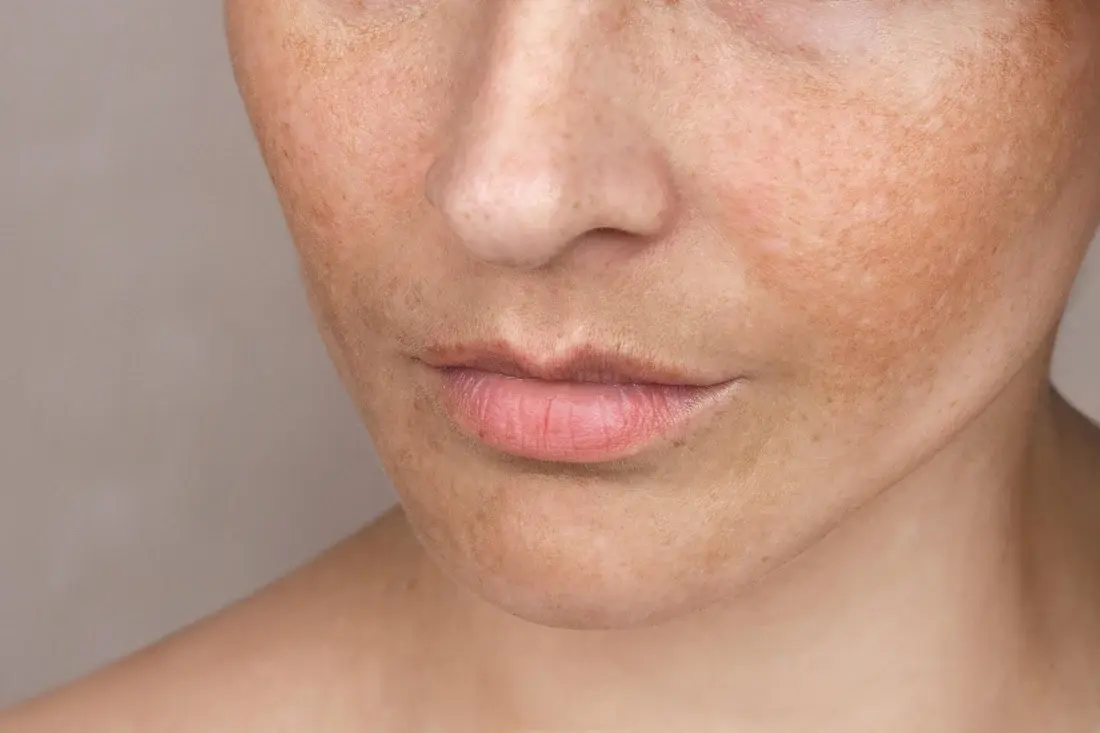 Pigmentation & Uneven Tone secondary product